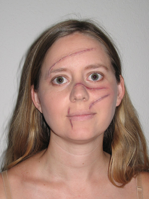 Dr. Saunders test (DH not FF)